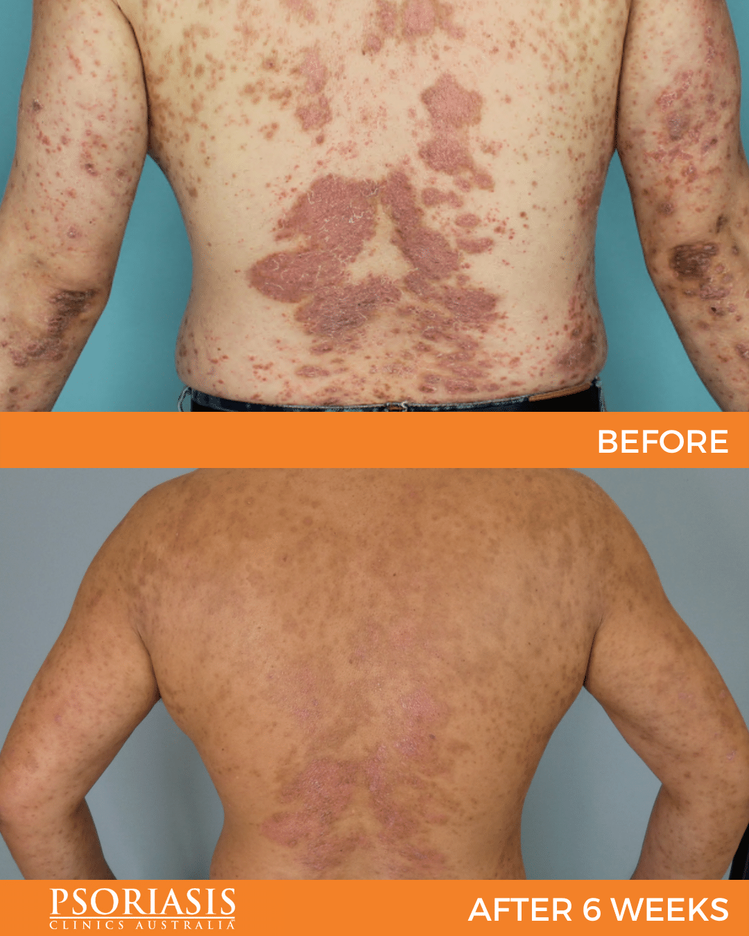 Psoriasis Before And After Treatment Psoriasis Clinics Australia