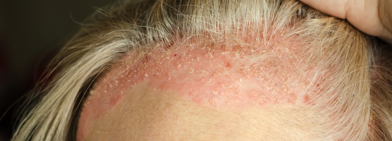 Can Psoriasis Cause Hair Loss Psoriasis Clinics Australia 