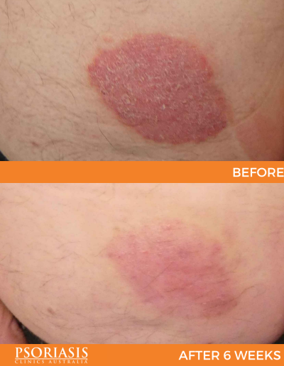 psoriasis treatment results