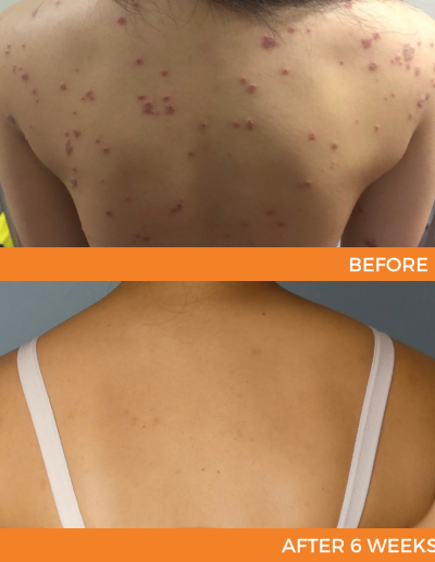 psoriasis treatment results