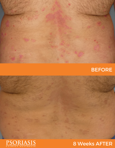 psoriasis treatment results