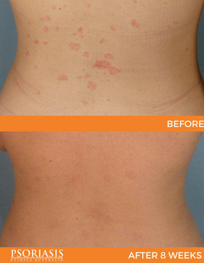 psoriasis treatment results