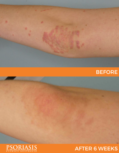 psoriasis treatment results