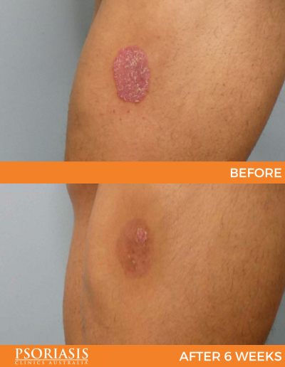 psoriasis treatment results