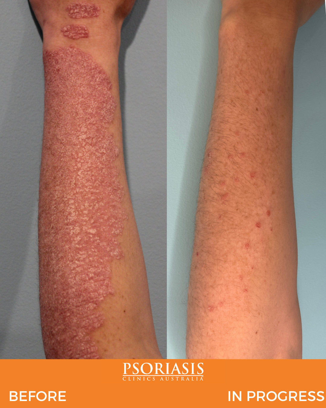 Psoriasis Specialist Gallery Psoriasis Clinics Australia 